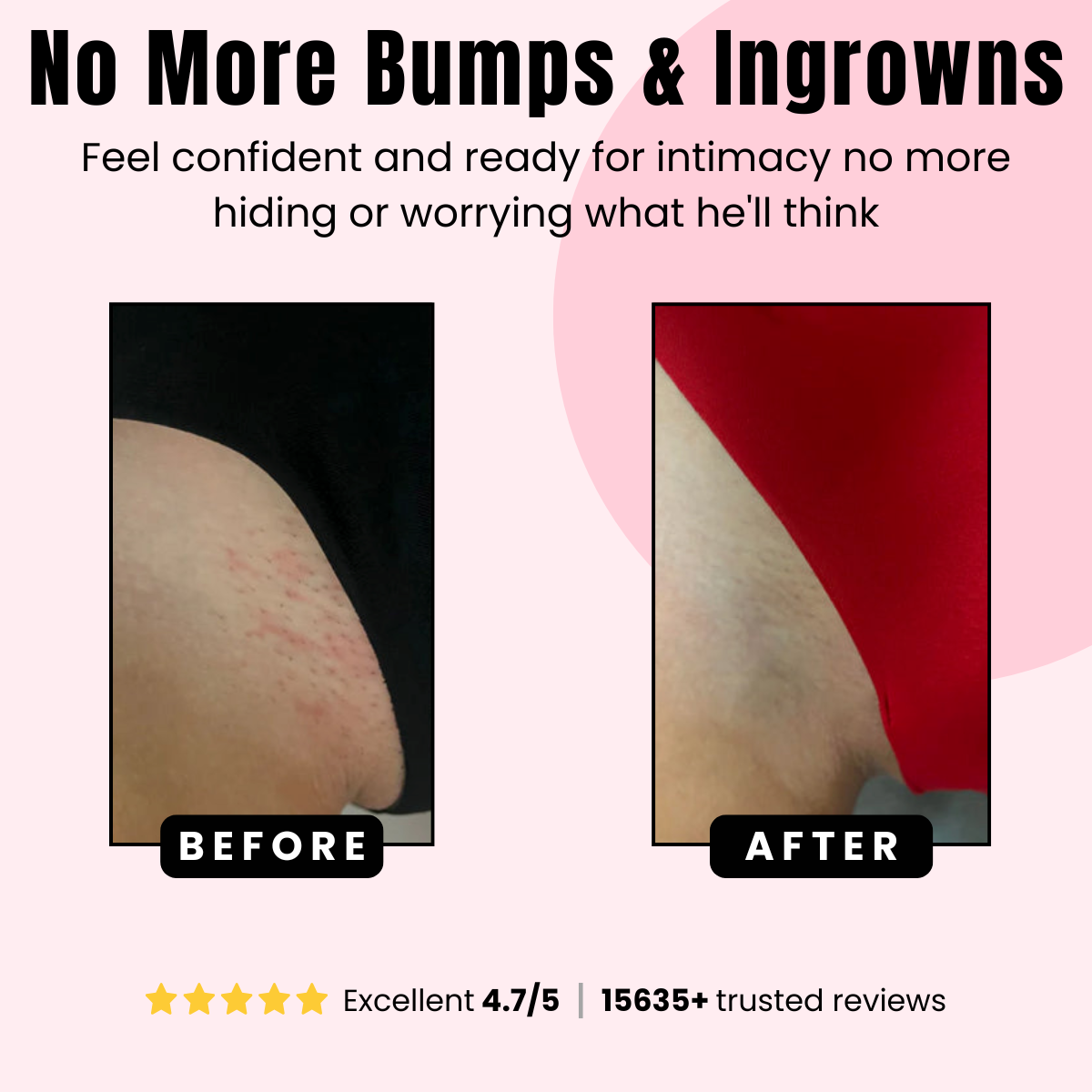 BioRecovery ingrown defense serum